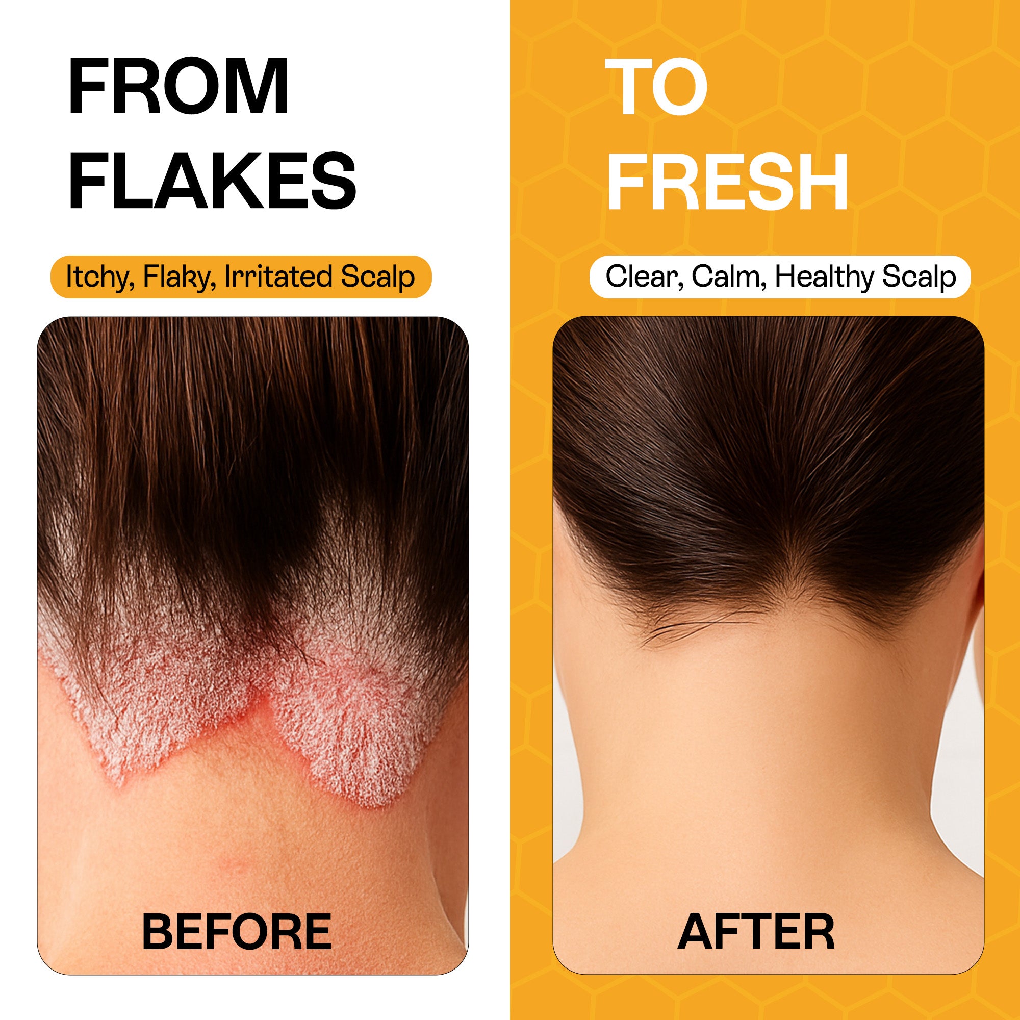 Psoriasis Shampoo for Dry, Itchy & Flaky Scalp | Eczema, Folliculitis & Seborrheic Dermatitis Care | Manuka Honey – 200ml