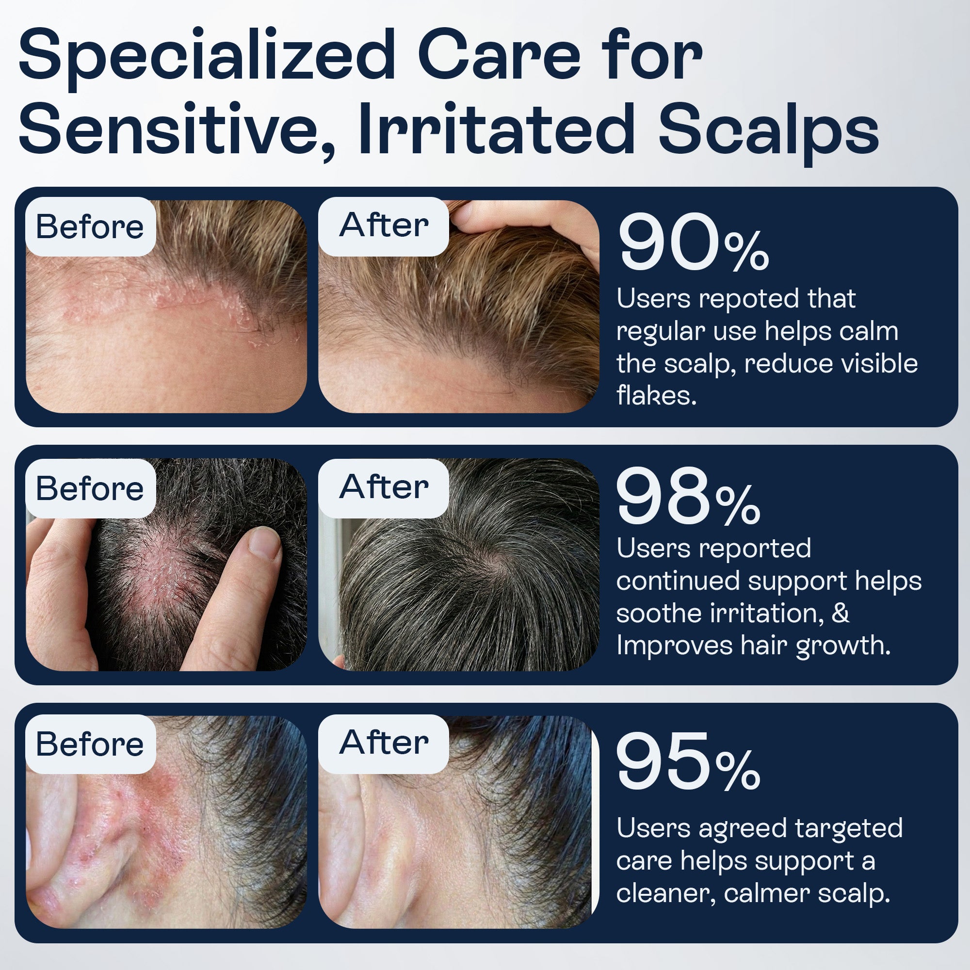 Psoriasis Scalp Spray for Flaking, Itching & Dryness