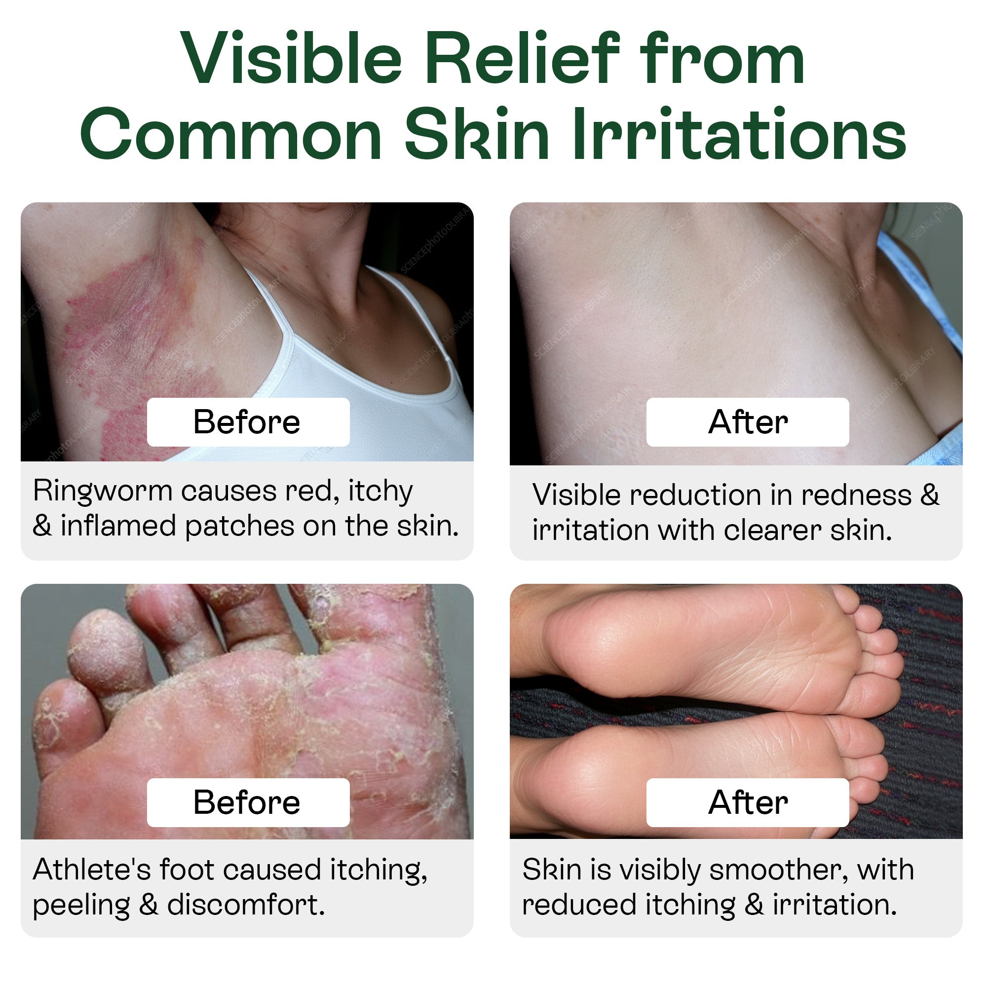 Medicated Antifungal Body Wipes for Ringworm, Jock Itch & Athlete’s Foot