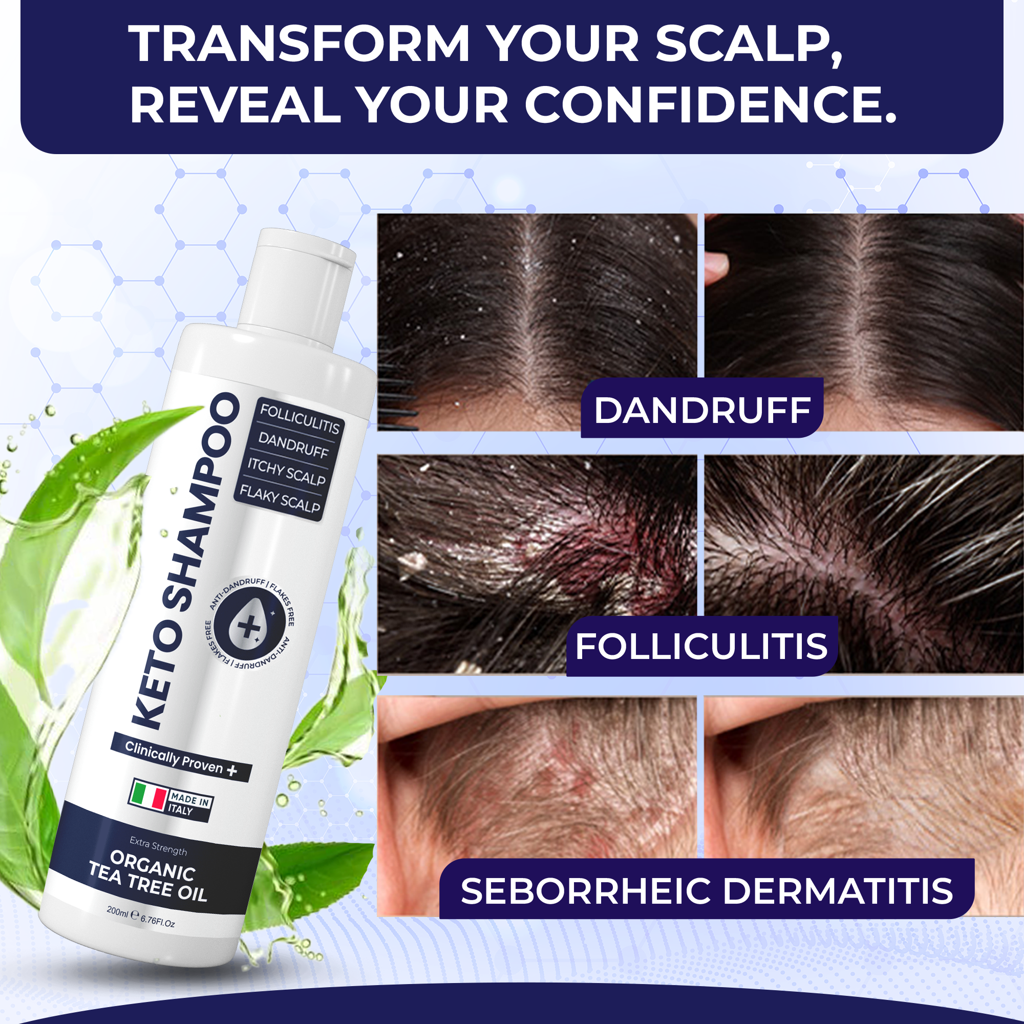 Keto Shampoo for Dandruff, Psoriasis, Folliculitis & Seborrheic Dermatitis | Anti-Fungal Itchy Scalp Relief