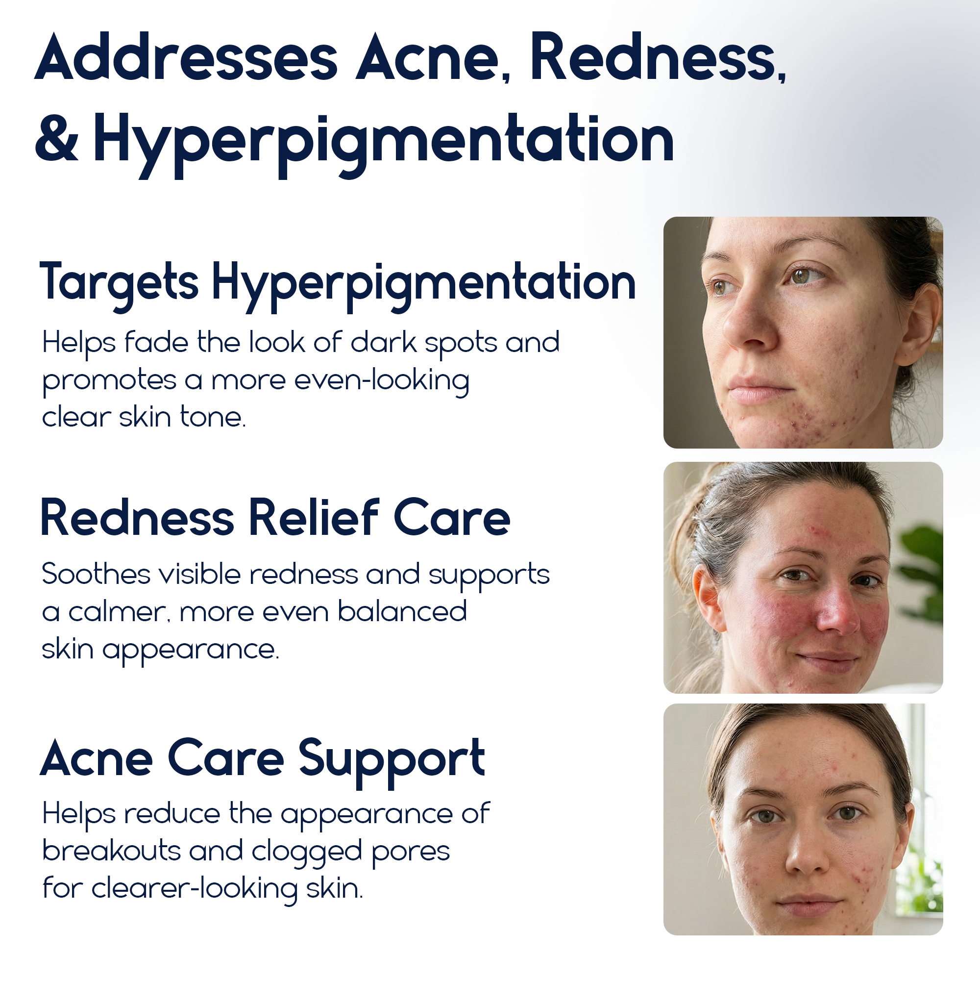 Azelaic Acid 15% Cream – Acne Control, Redness Relief & Tone Correction | 30ml