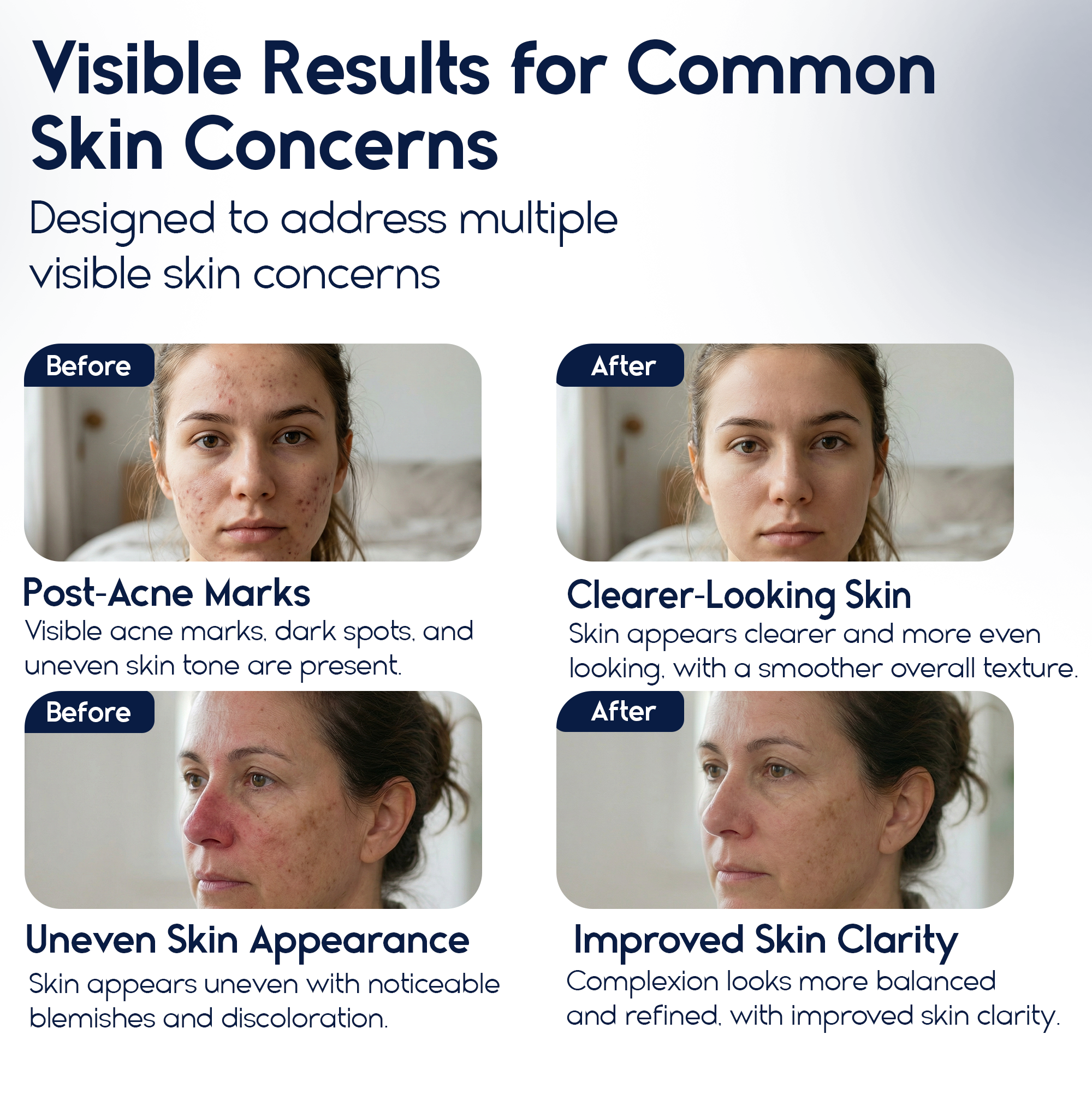 Azelaic Acid 15% Cream – Acne Control, Redness Relief & Tone Correction | 30ml