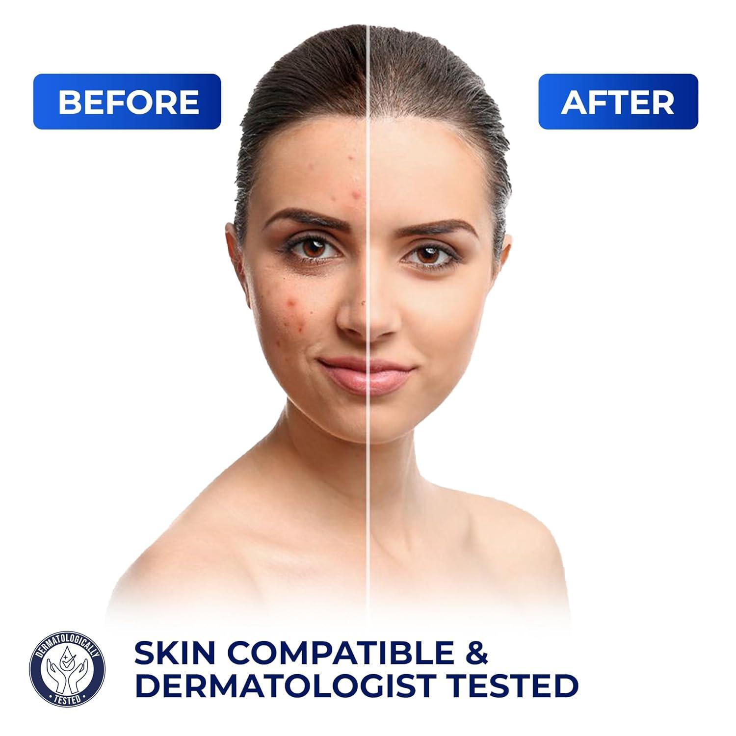 Advanced Azelaic Acid 10% Cream: Redness relief, Rosacea & Dark spot treatment. Soothes acne, Hyperpigmentation & Brightens your skin! - Pharmlitalia