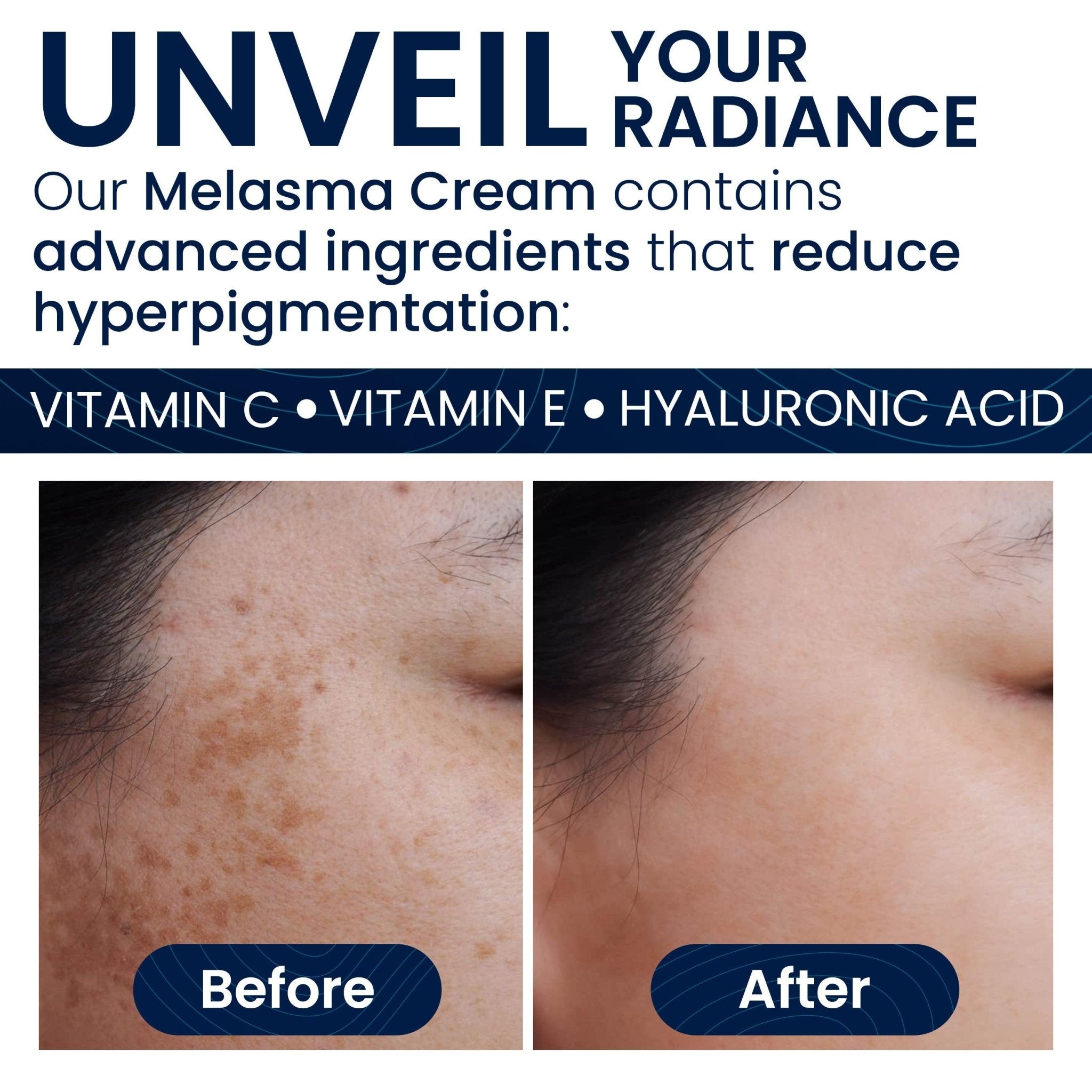 Melasma Treatment for Face & Body Cream: Reduces Dark Spots, Age Spots and Promotes Even - Toned Skin with Vitamin C - Pharmlitalia