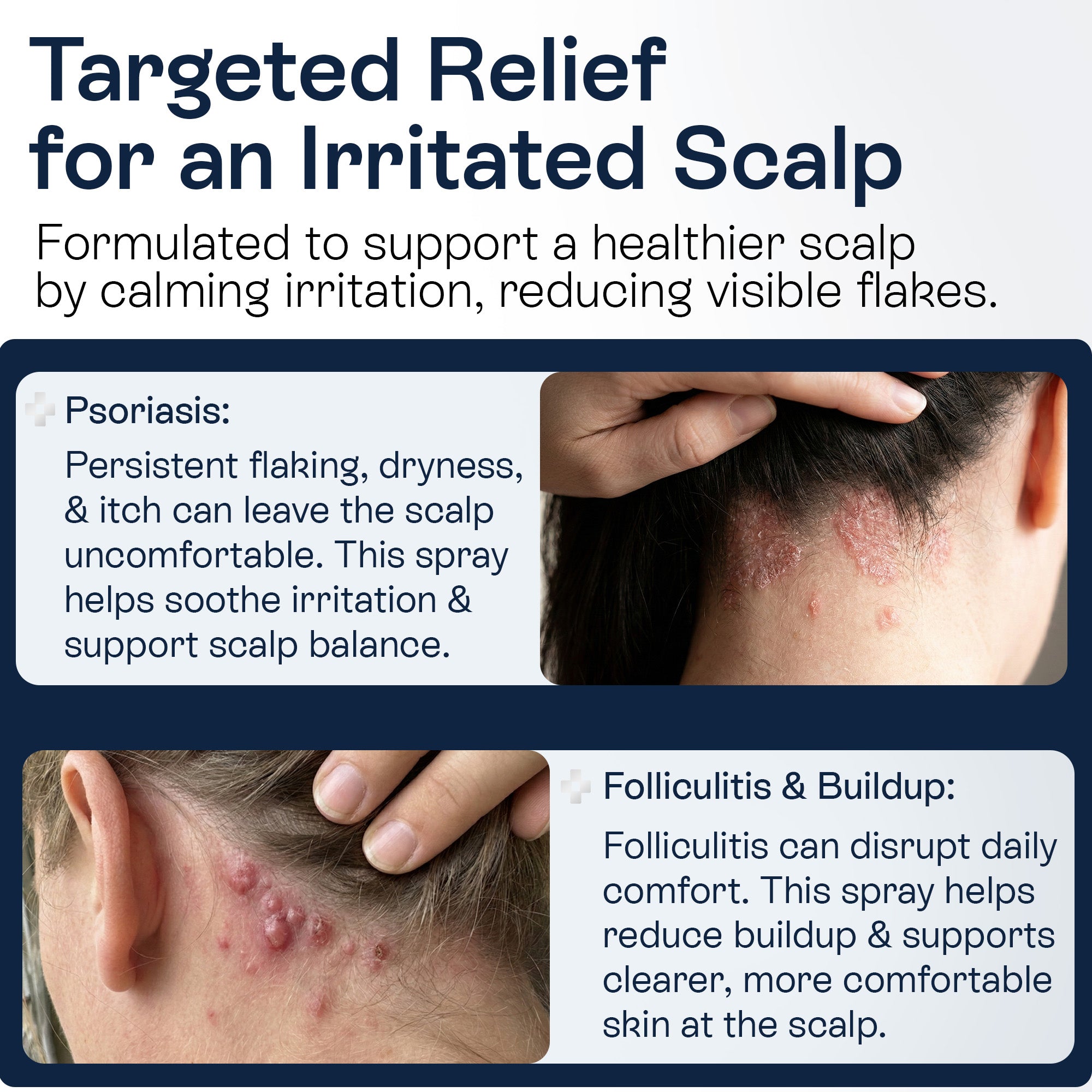 Psoriasis Scalp Spray for Flaking, Itching &amp; Dryness