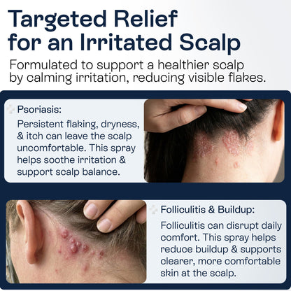 Psoriasis Scalp Spray for Flaking, Itching &amp; Dryness