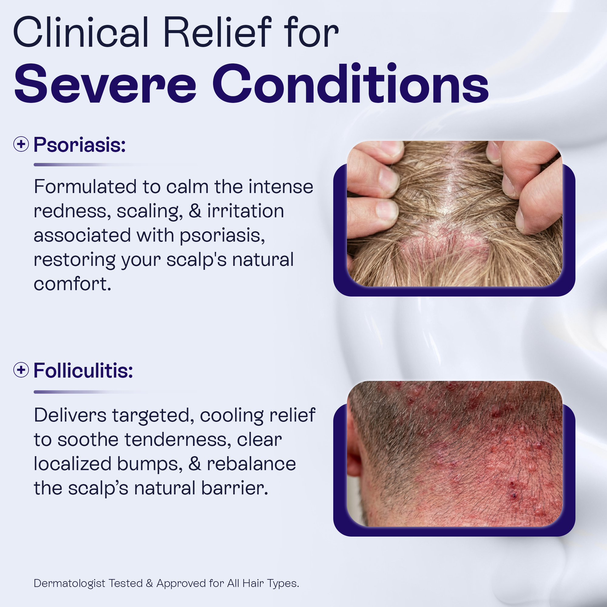 Keto Conditioner | Anti-Dandruff &amp; Scalp Relief Care
