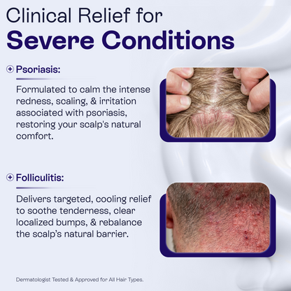 Keto Conditioner | Anti-Dandruff &amp; Scalp Relief Care