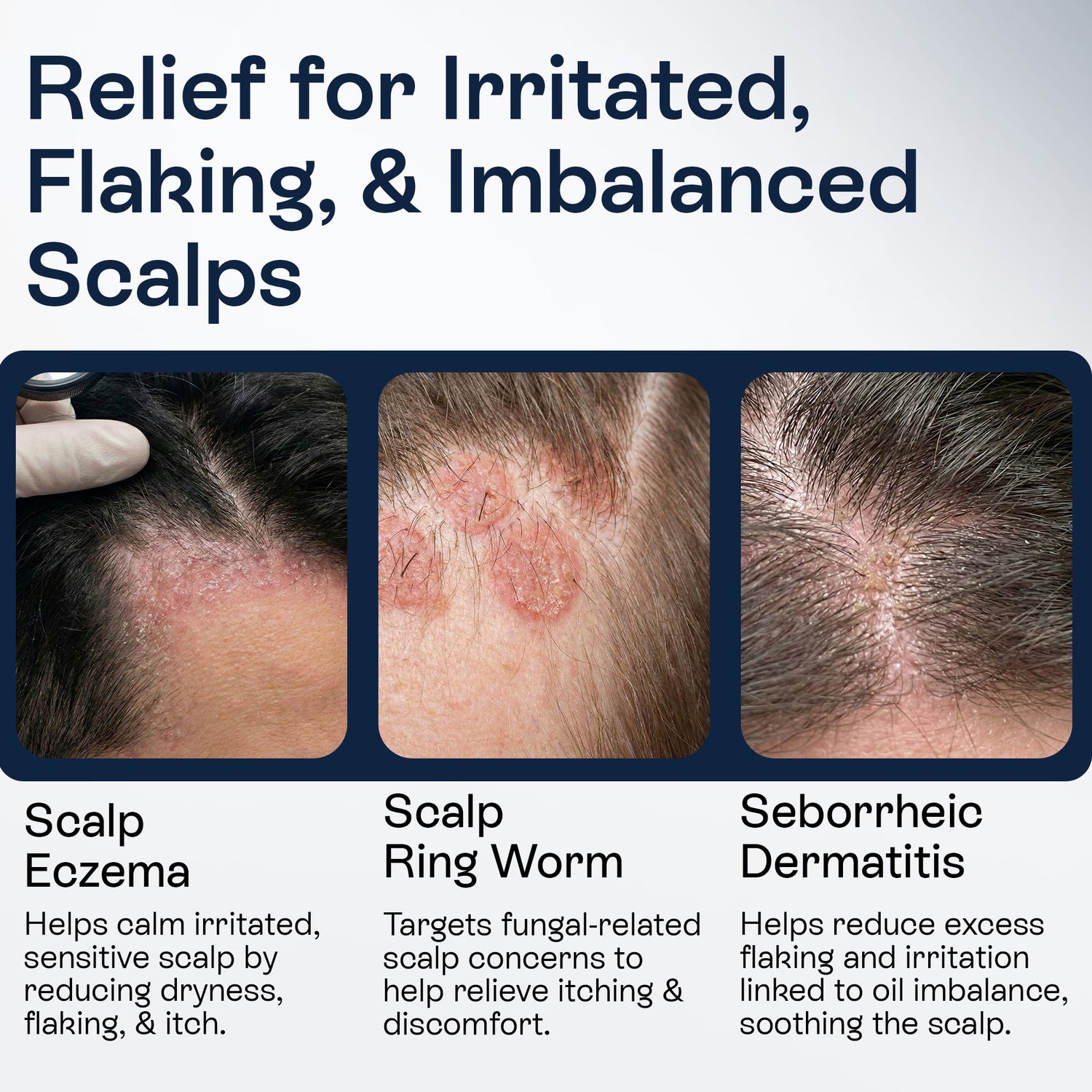 Psoriasis Scalp Spray for Flaking, Itching &amp; Dryness