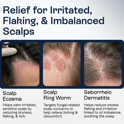Psoriasis Scalp Spray for Flaking, Itching &amp; Dryness