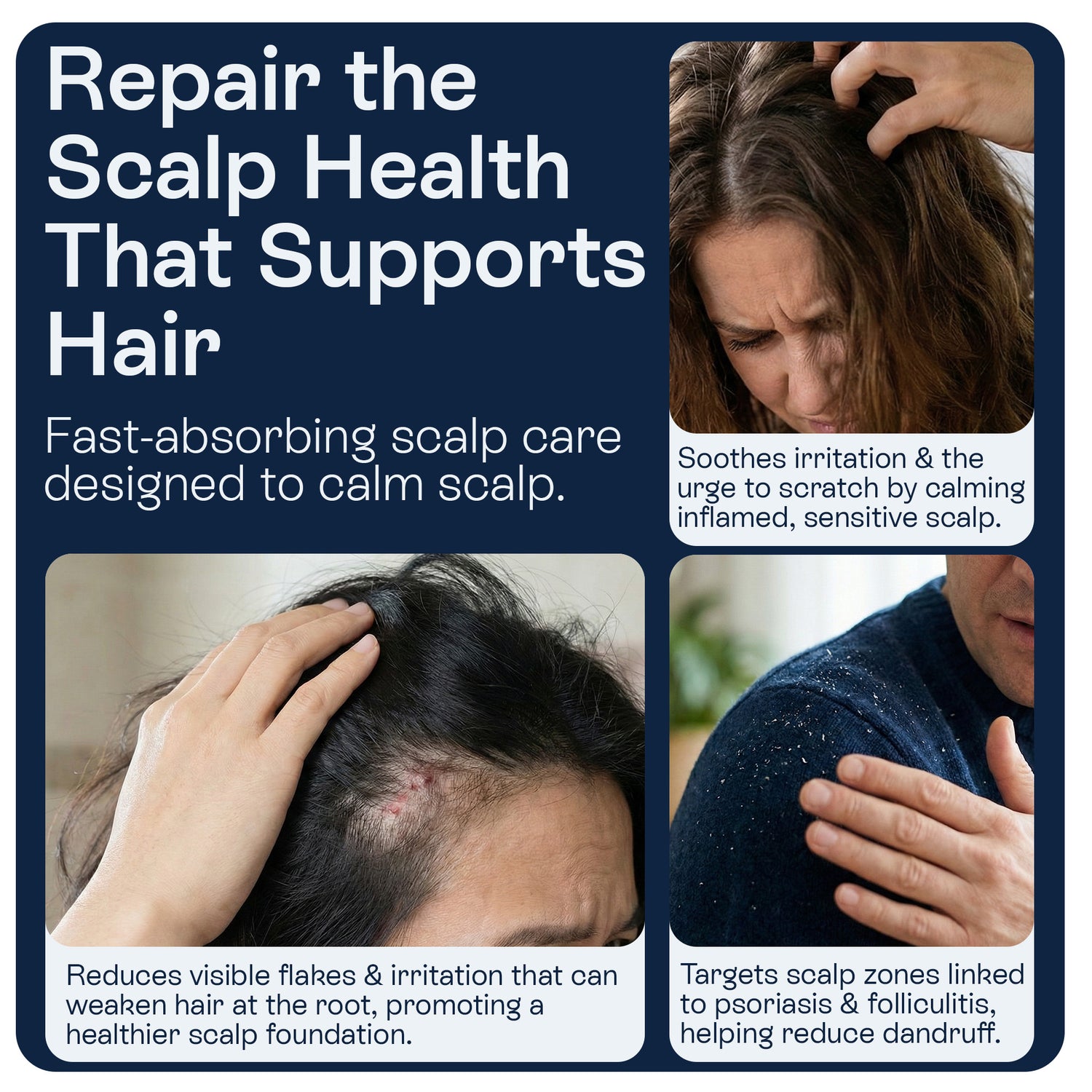 Psoriasis Scalp Spray for Flaking, Itching &amp; Dryness