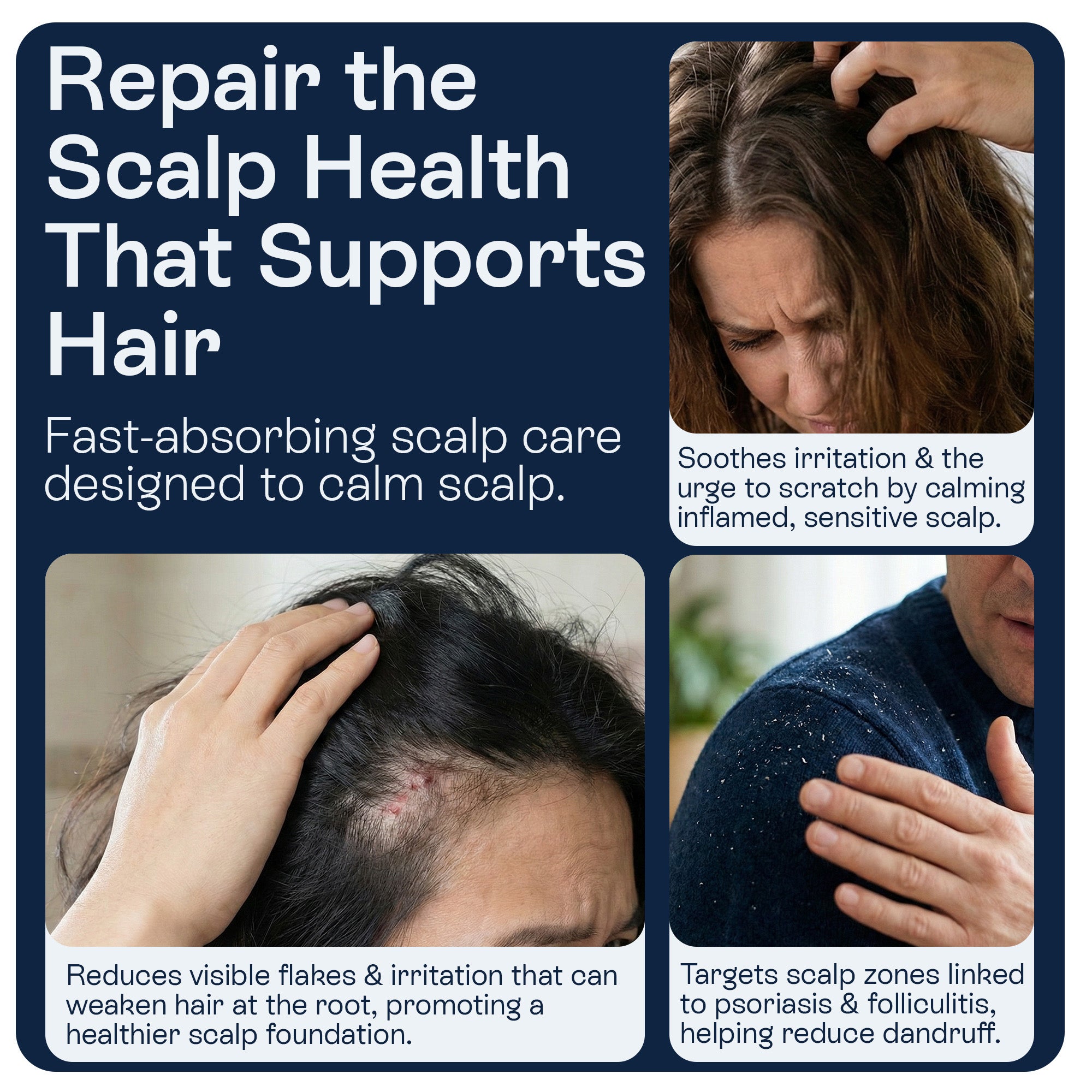 Psoriasis Scalp Spray for Flaking, Itching &amp; Dryness