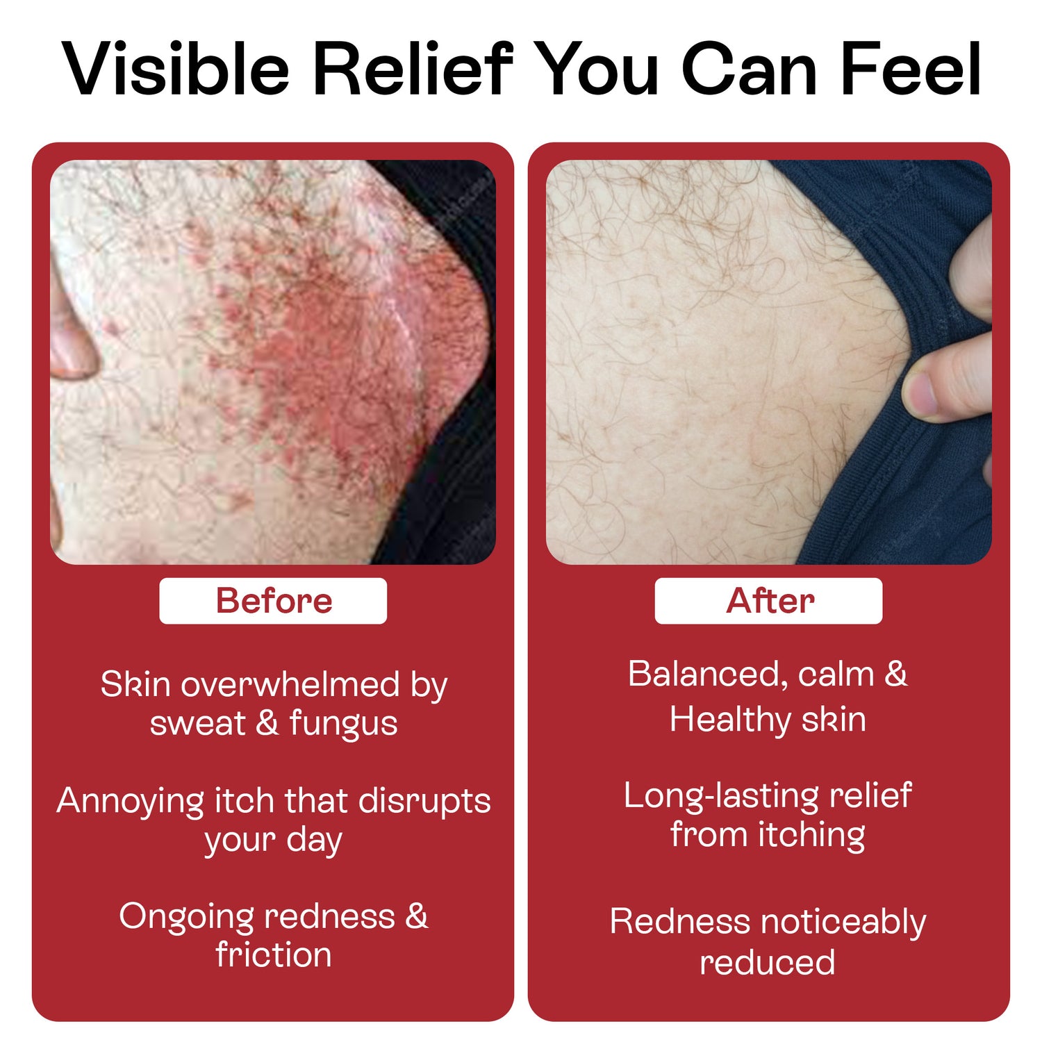 Jock Itch Antifungal Cream for Itching, Redness &amp; Odor Relief