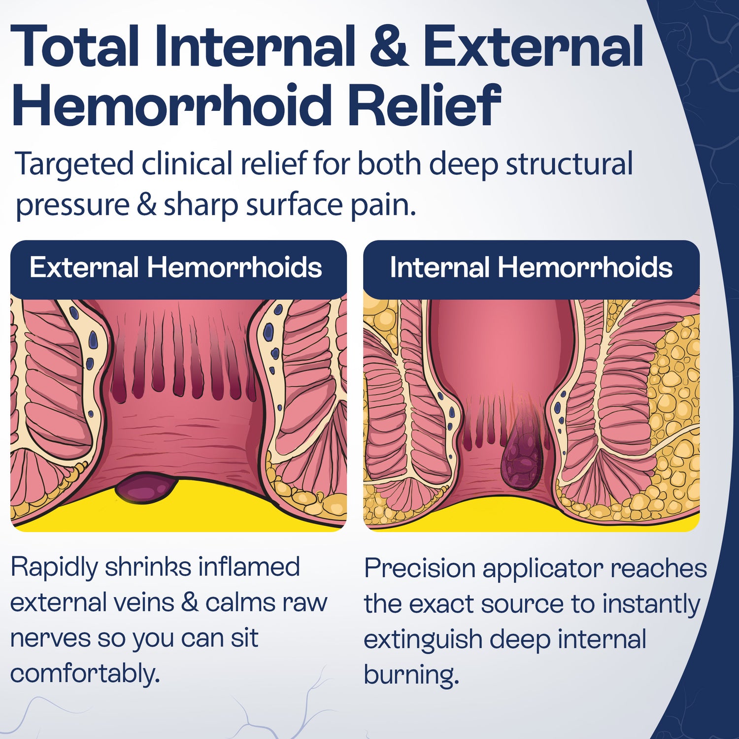 Hemorrhoid Cream | Fast Relief for Pain, Itching &amp; Discomfort