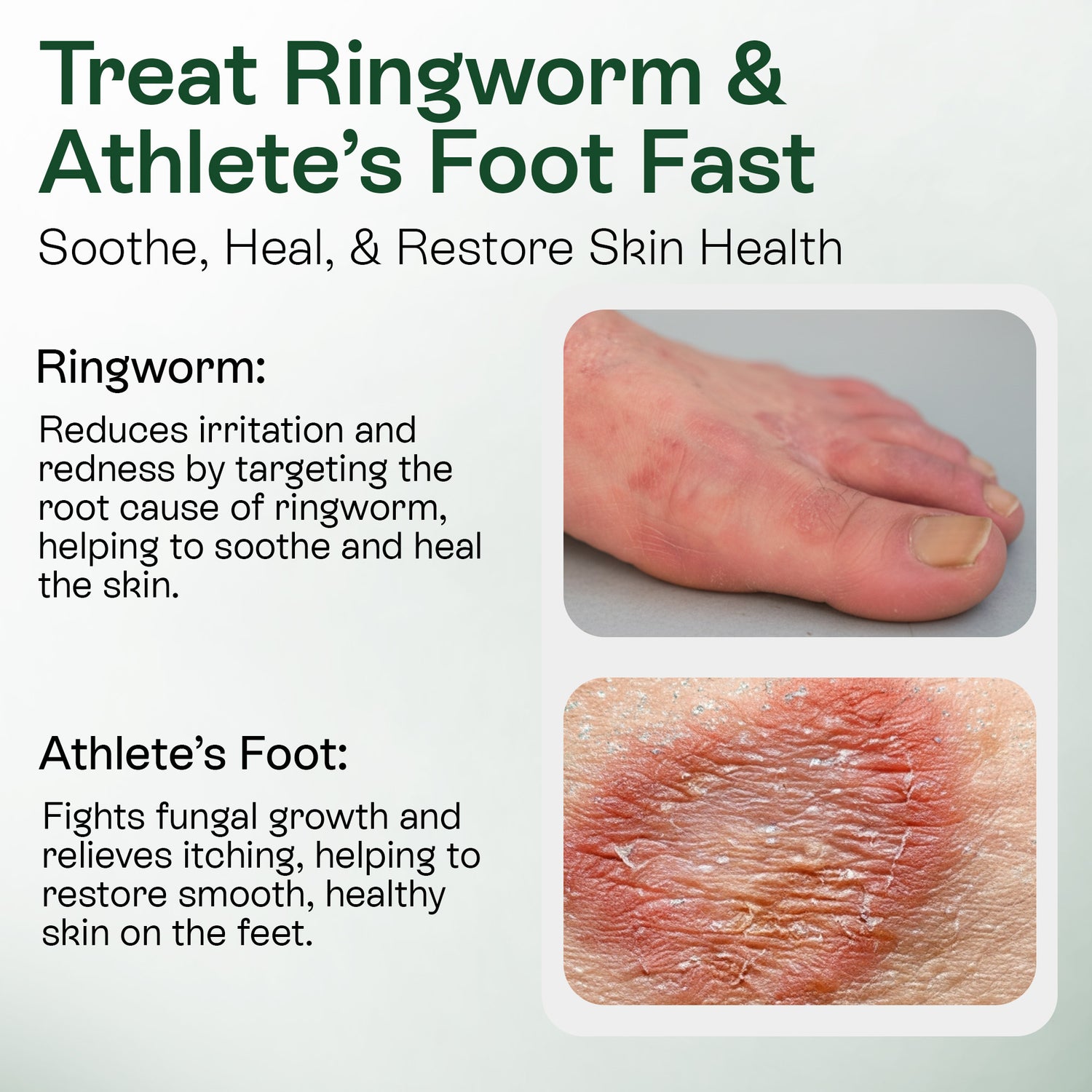 Medicated Antifungal Body Wipes for Ringworm, Jock Itch &amp; Athlete’s Foot