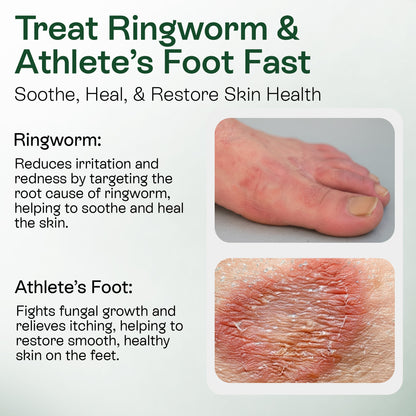 Medicated Antifungal Body Wipes for Ringworm, Jock Itch &amp; Athlete’s Foot
