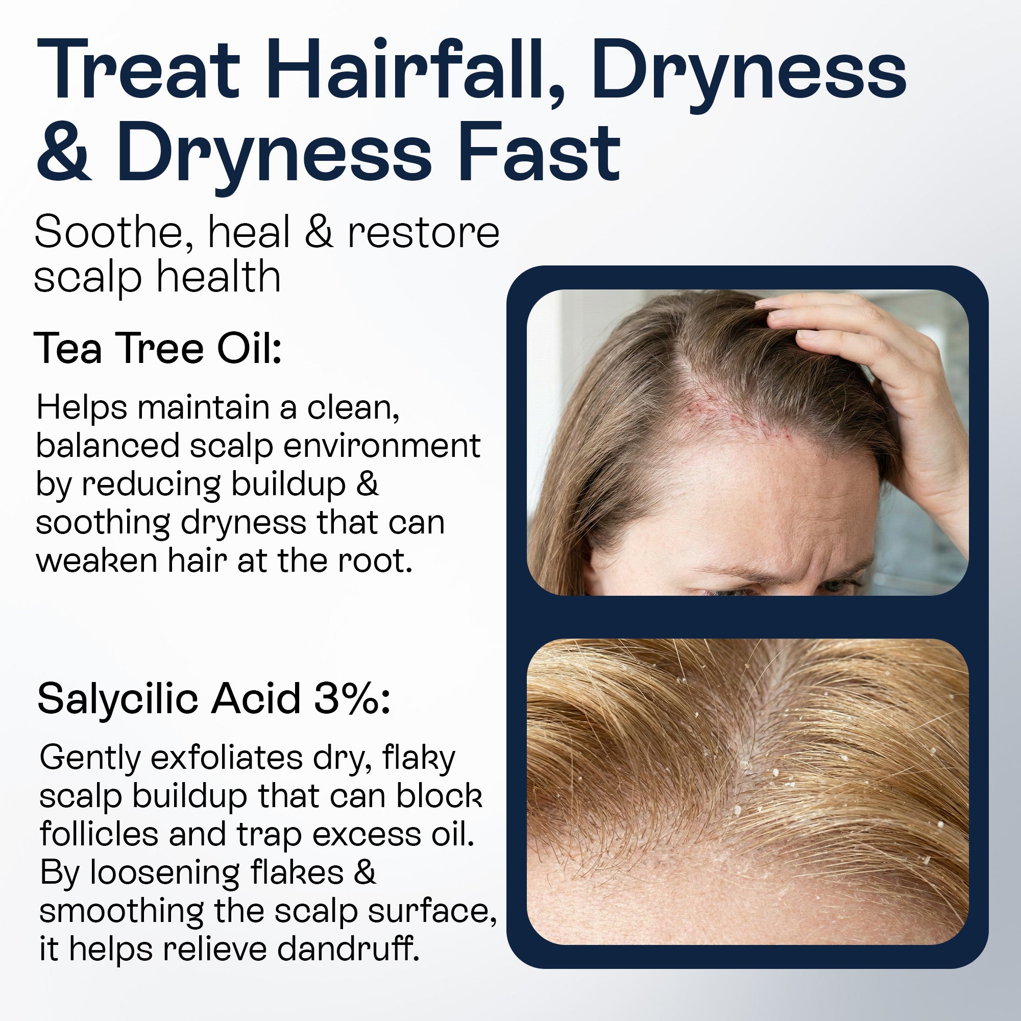 Psoriasis Scalp Spray for Flaking, Itching &amp; Dryness