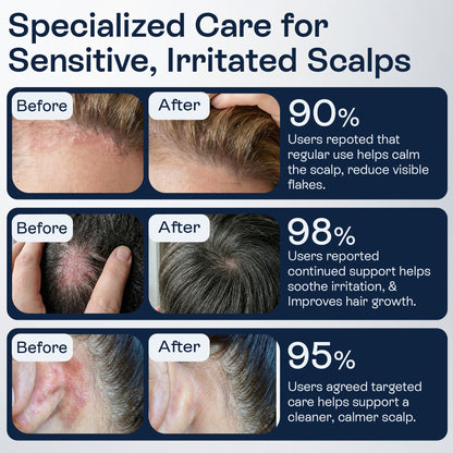 Psoriasis Scalp Spray for Flaking, Itching &amp; Dryness
