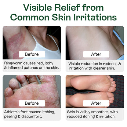 Medicated Antifungal Body Wipes for Ringworm, Jock Itch &amp; Athlete’s Foot