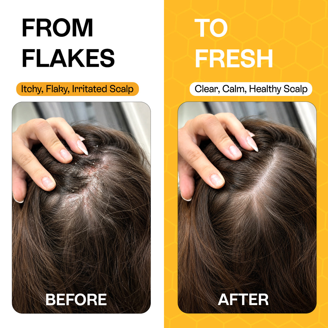 Psoriasis Shampoo for Dry, Itchy &amp; Flaky Scalp | Eczema, Folliculitis &amp; Seborrheic Dermatitis Care | Manuka Honey – 200ml