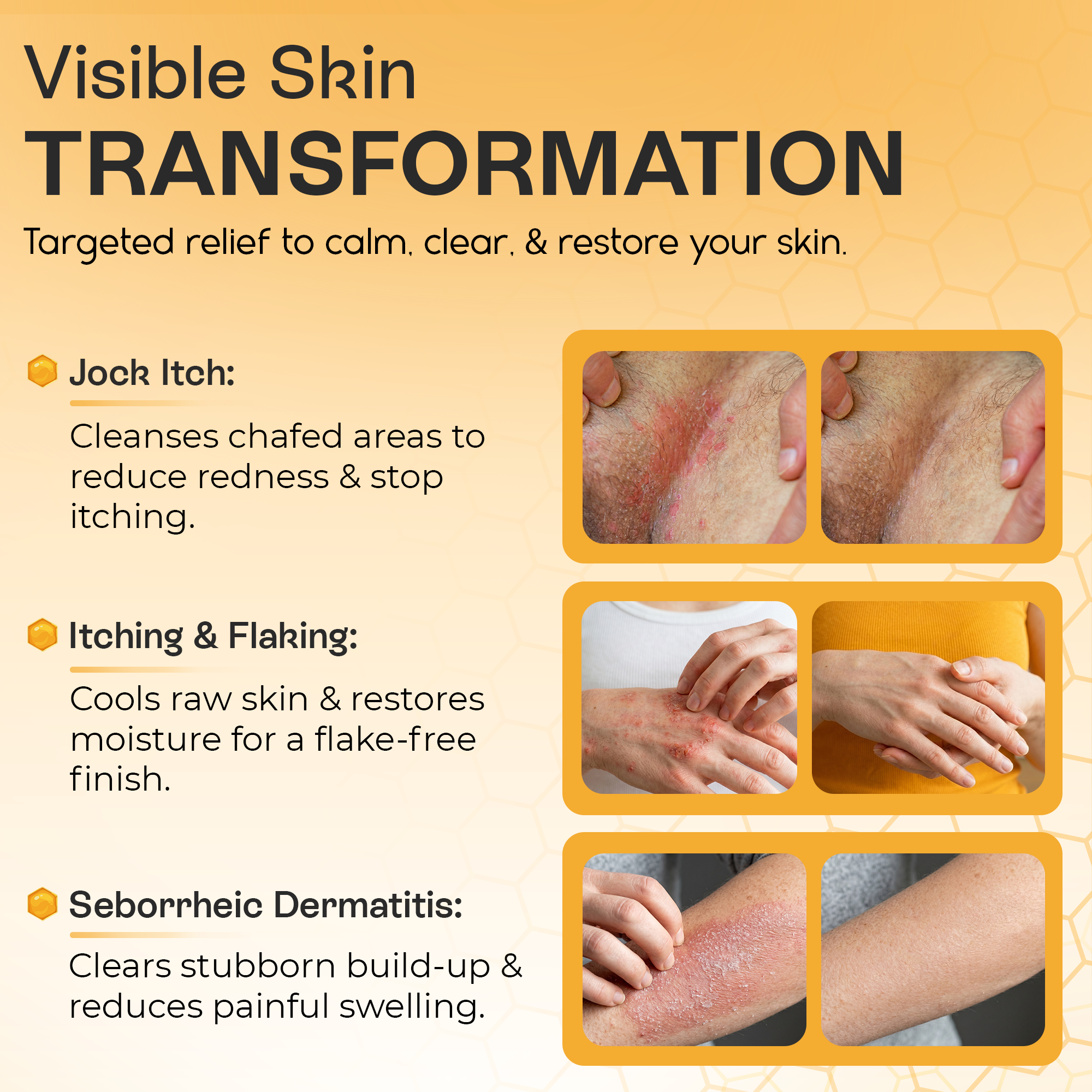 Psoriasis Body Wash | Itch, Redness &amp; Flake Relief