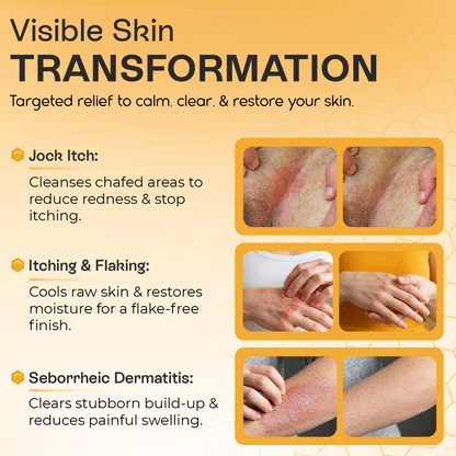 Psoriasis Body Wash | Itch, Redness &amp; Flake Relief