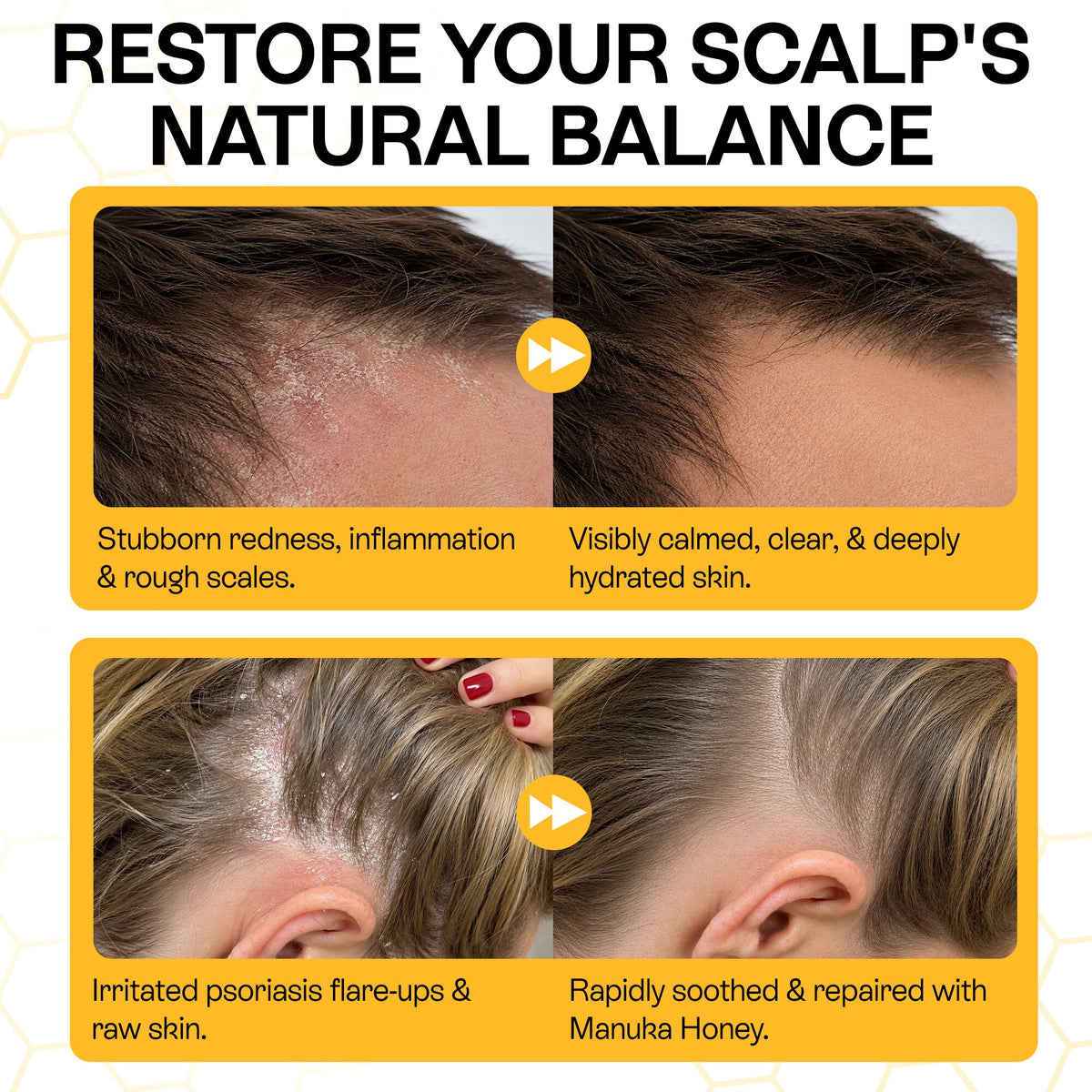 Psoriasis Shampoo for Dry, Itchy &amp; Flaky Scalp | Eczema, Folliculitis &amp; Seborrheic Dermatitis Care | Manuka Honey – 200ml