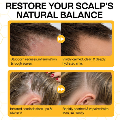Psoriasis Shampoo for Dry, Itchy &amp; Flaky Scalp | Eczema, Folliculitis &amp; Seborrheic Dermatitis Care | Manuka Honey – 200ml