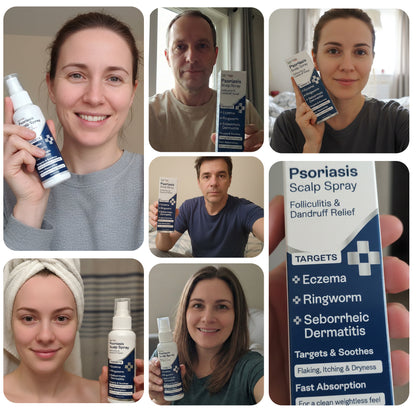 Psoriasis Scalp Spray for Flaking, Itching &amp; Dryness