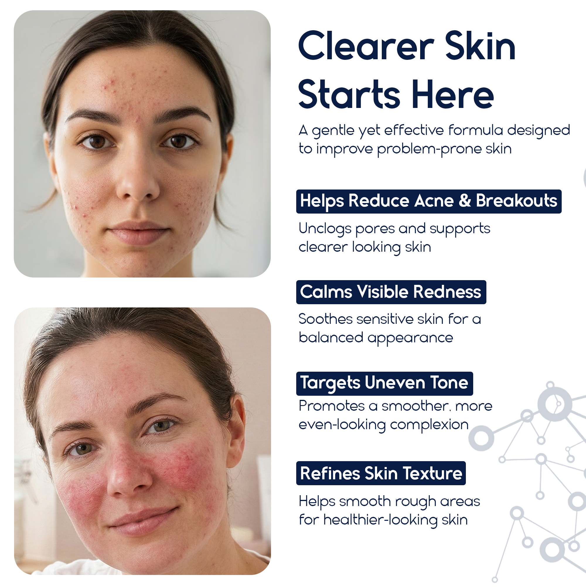 Azelaic Acid 15% Cream – Acne Control, Redness Relief &amp; Tone Correction | 30ml