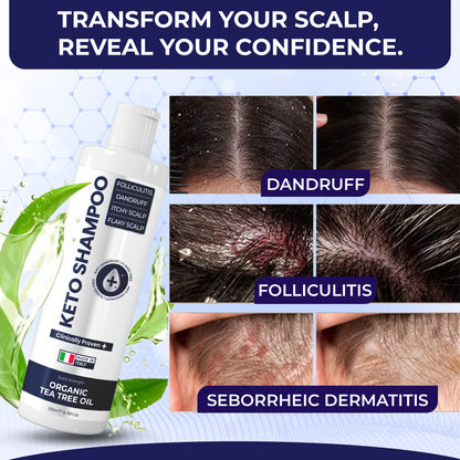 Keto Shampoo for Dandruff, Psoriasis, Folliculitis &amp; Seborrheic Dermatitis | Anti-Fungal Itchy Scalp Relief