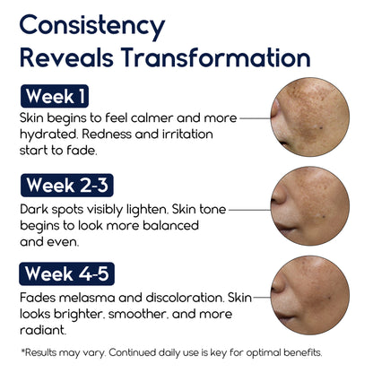 Melasma Cream &amp; Age Spot Remover for Skin Discoloration, Post-Blemish Marks, Scars &amp; Spots