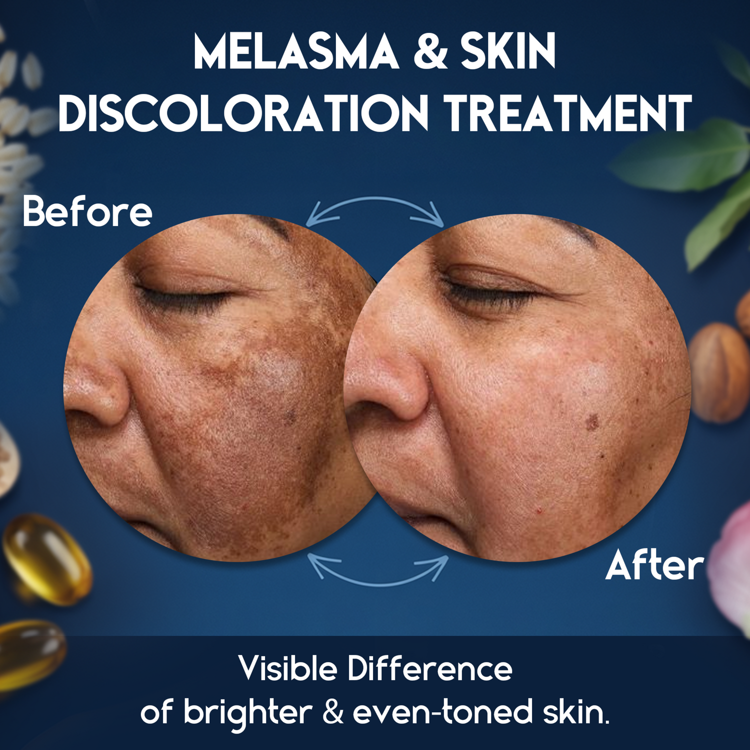 Melasma Cream &amp; Age Spot Remover for Skin Discoloration, Post-Blemish Marks, Scars &amp; Spots