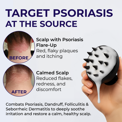 Keto Shampoo for Dandruff, Psoriasis, Folliculitis &amp; Seborrheic Dermatitis | Anti-Fungal Itchy Scalp Relief